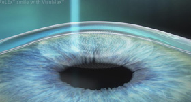 眼膜医学动画  MG动画